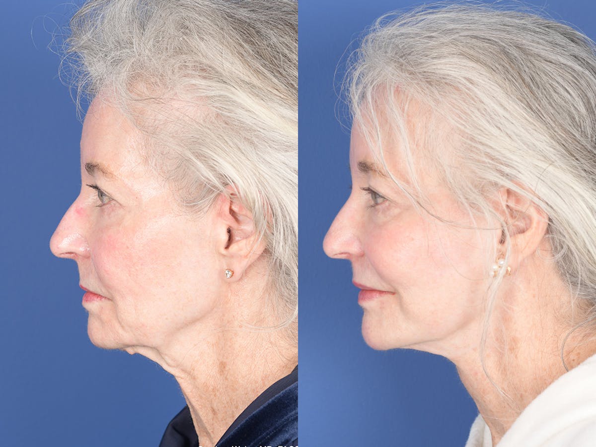 Facelift Before & After Gallery - Patient 291451 - Image 2