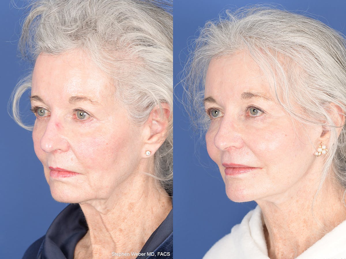 Facelift Before & After Gallery - Patient 291451 - Image 3
