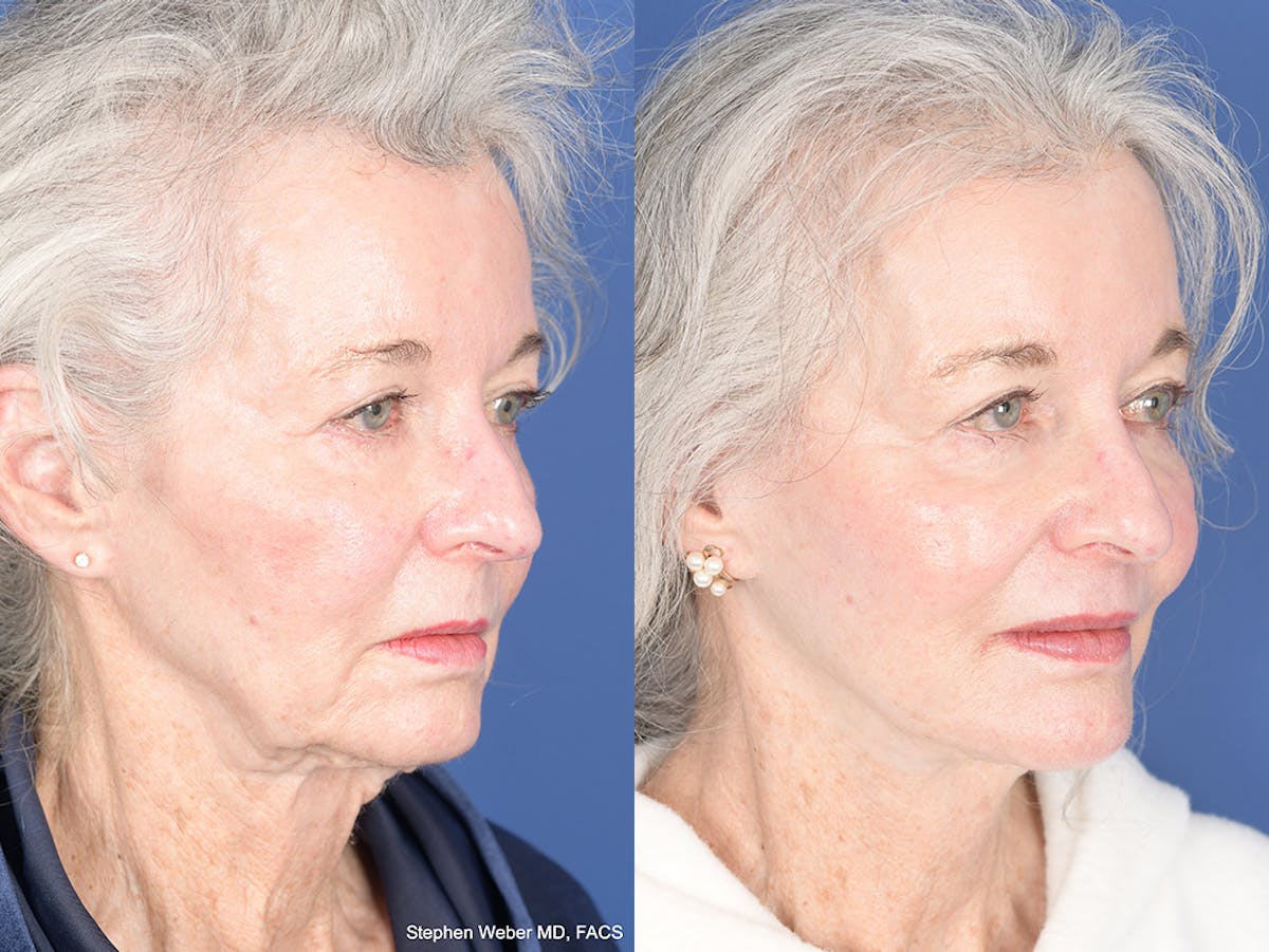 Facelift Before & After Gallery - Patient 291451 - Image 4