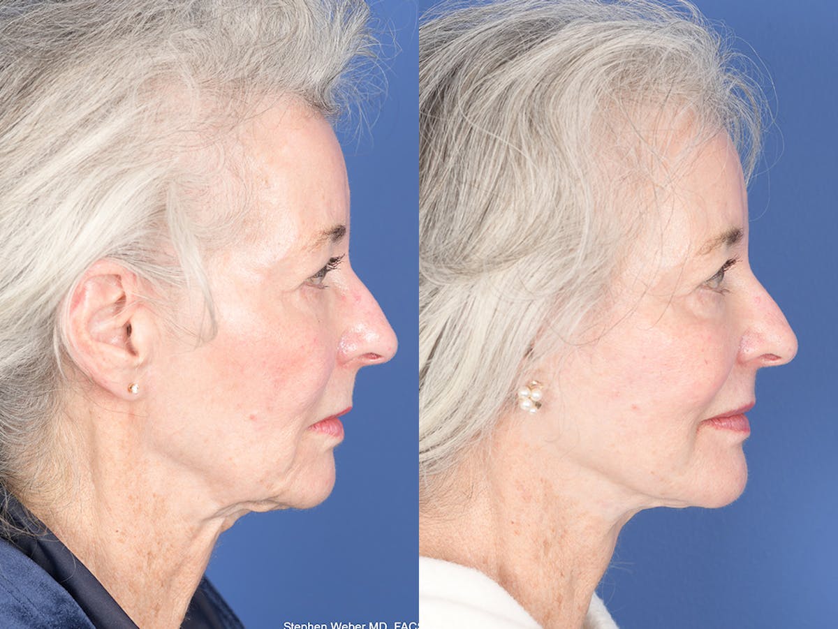 Facelift Before & After Gallery - Patient 291451 - Image 5