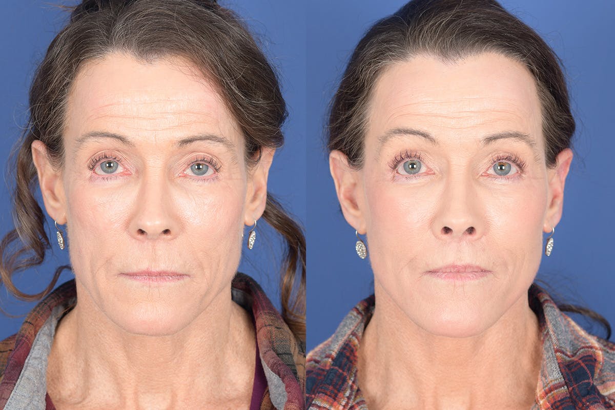 Facelift Before & After Gallery - Patient 217160 - Image 1