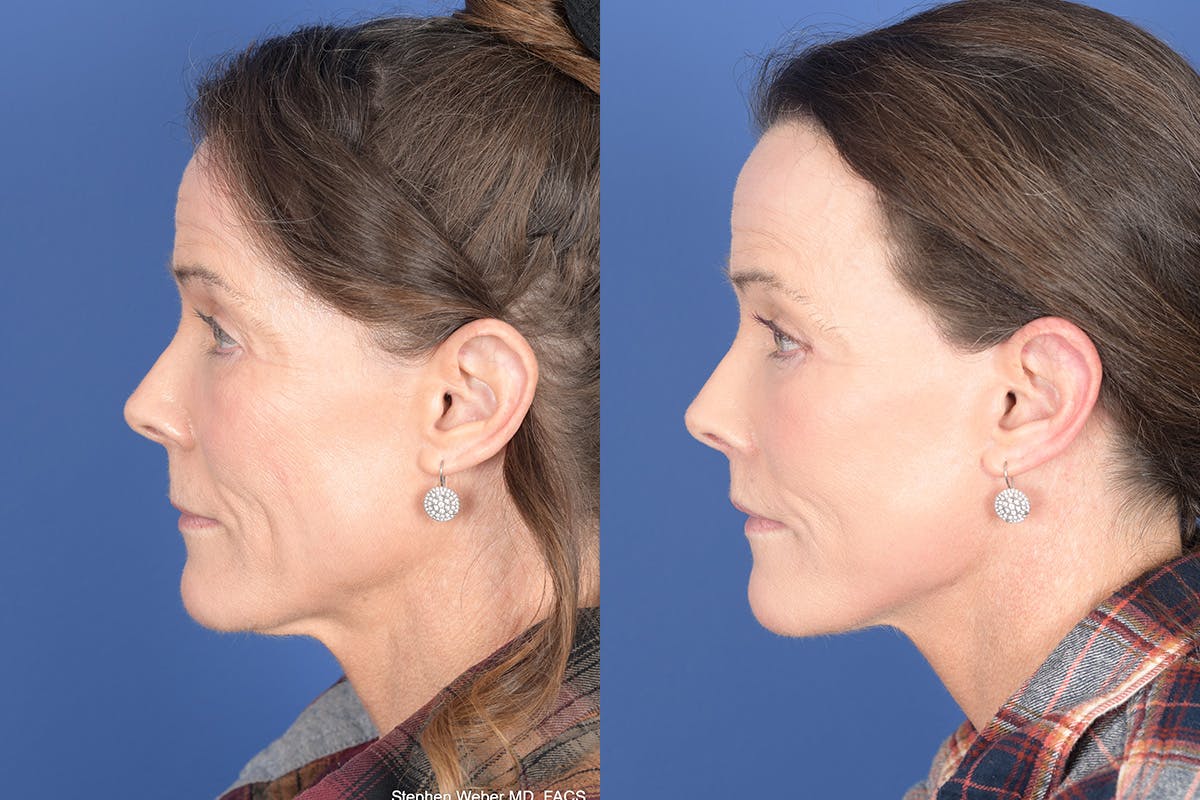 Facelift Before & After Gallery - Patient 217160 - Image 2