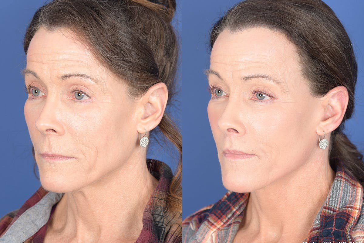 Facelift Before & After Gallery - Patient 217160 - Image 3