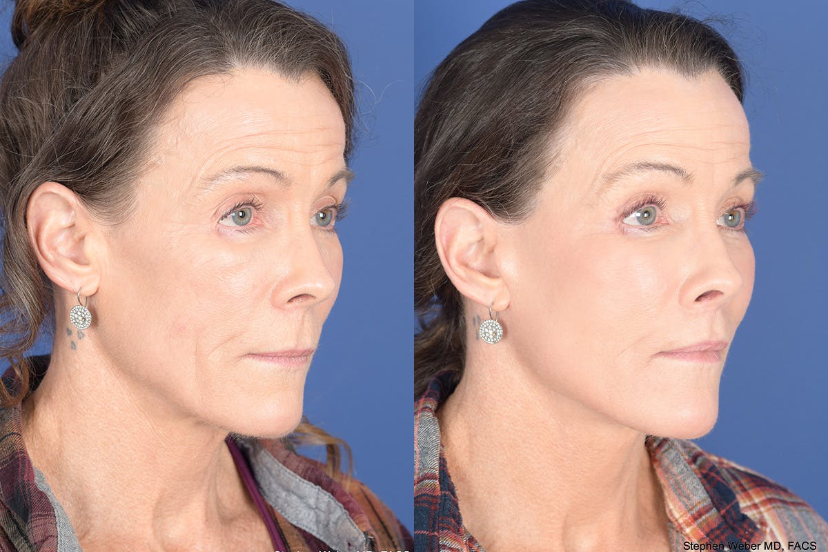 Facelift Before & After Gallery - Patient 217160 - Image 4