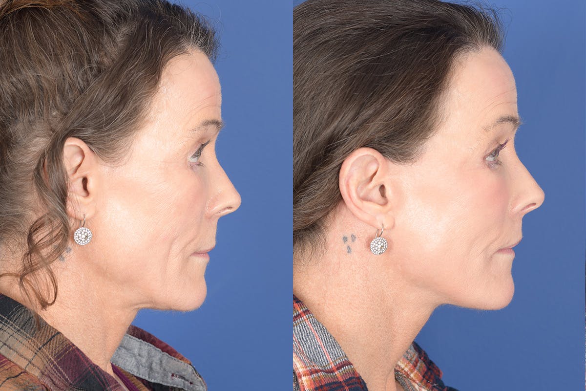 Facelift Before & After Gallery - Patient 217160 - Image 5