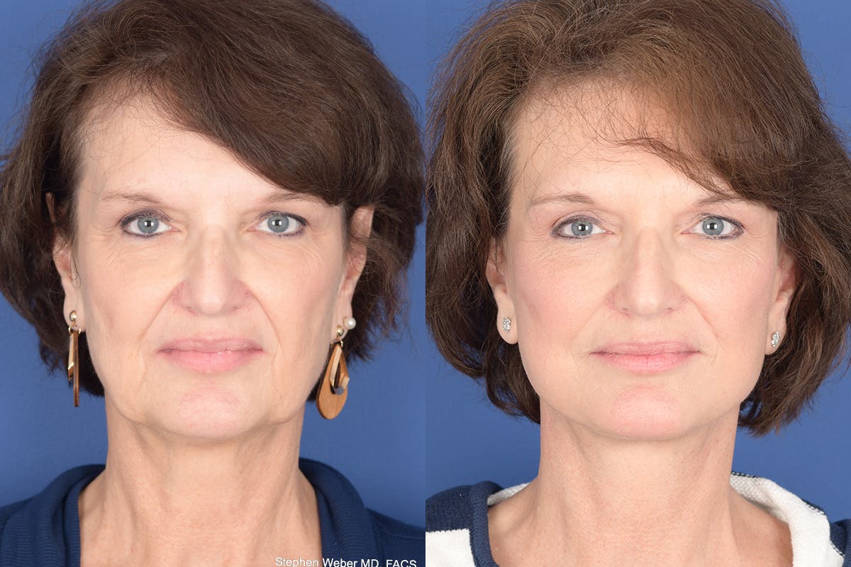 Facelift Before & After Gallery - Patient 334563 - Image 1