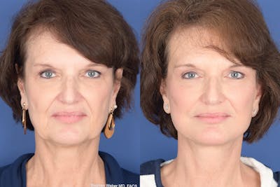 Facelift Before & After Gallery - Patient 334563 - Image 1
