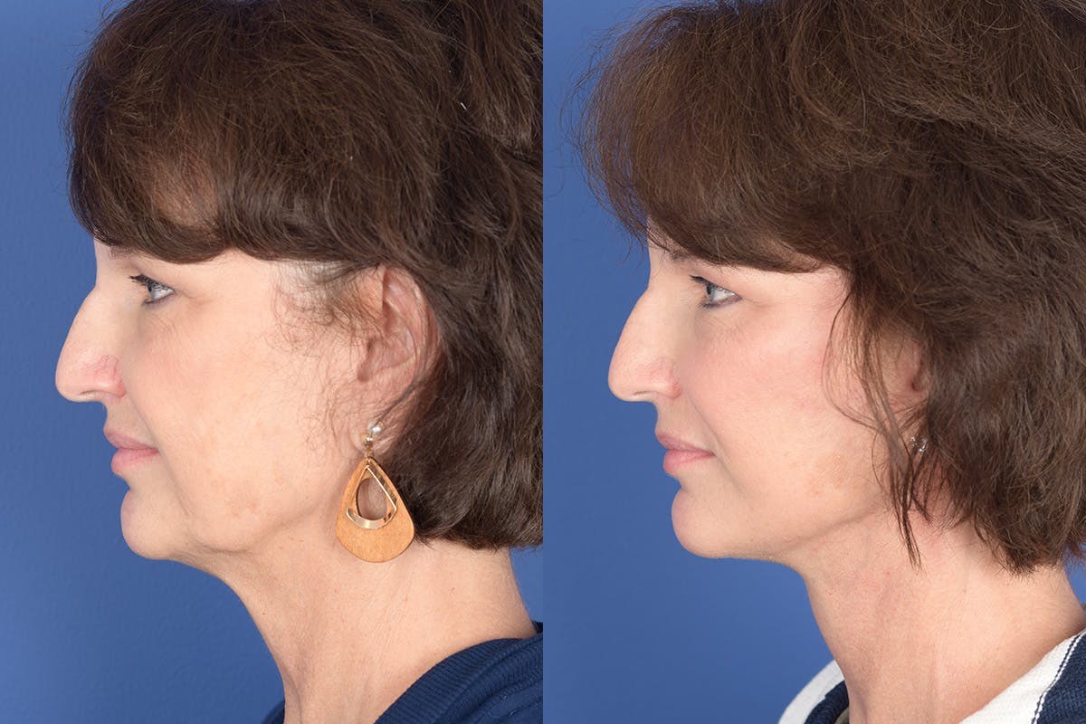 Facelift Before & After Gallery - Patient 334563 - Image 2