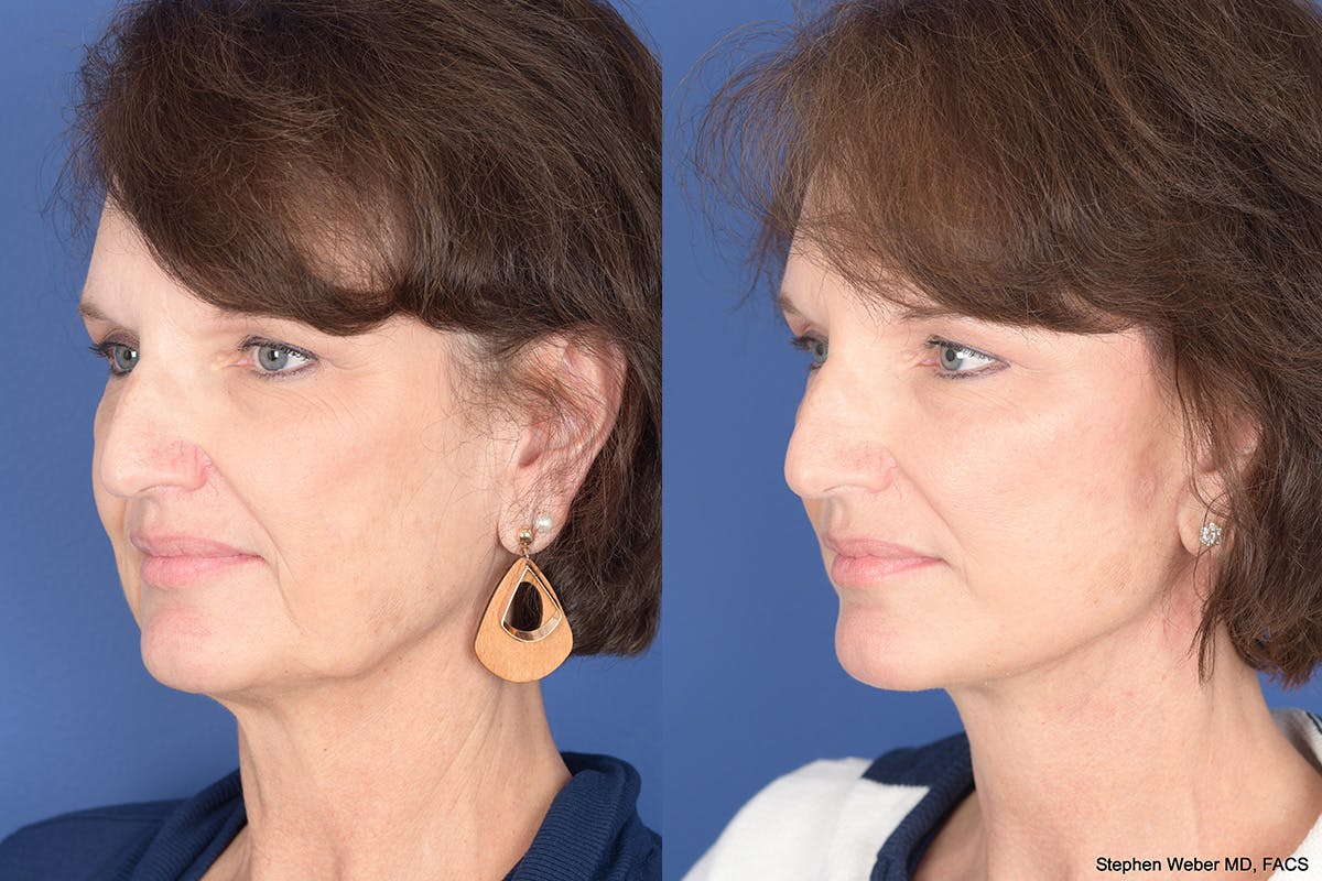 Facelift Before & After Gallery - Patient 334563 - Image 3