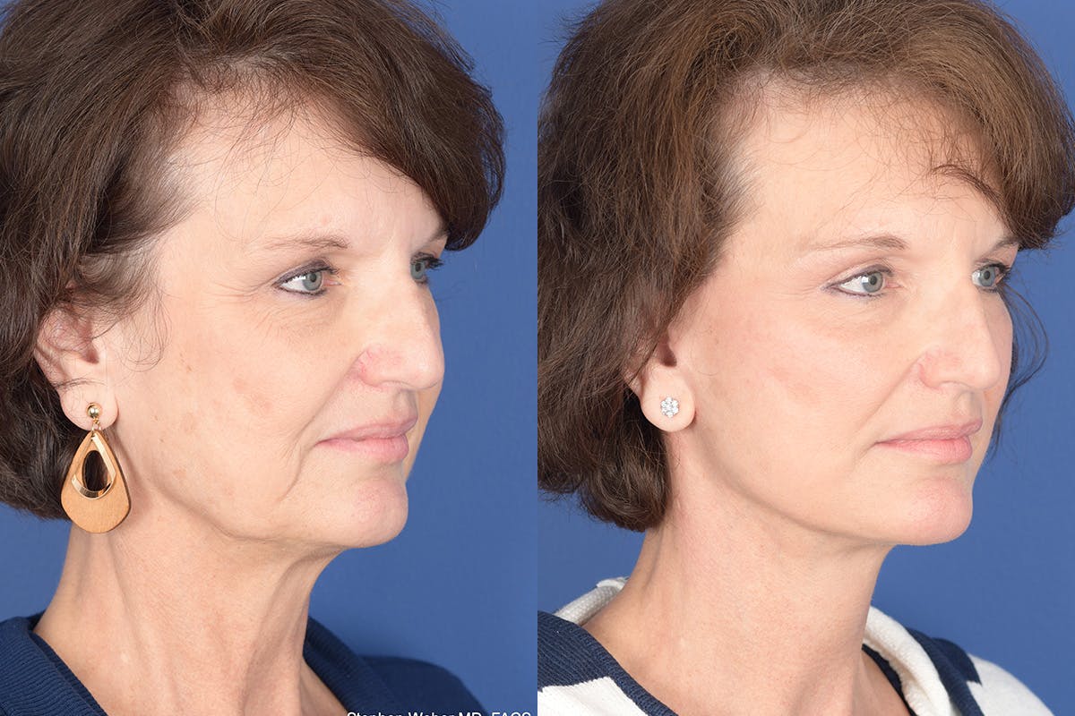 Facelift Before & After Gallery - Patient 334563 - Image 4