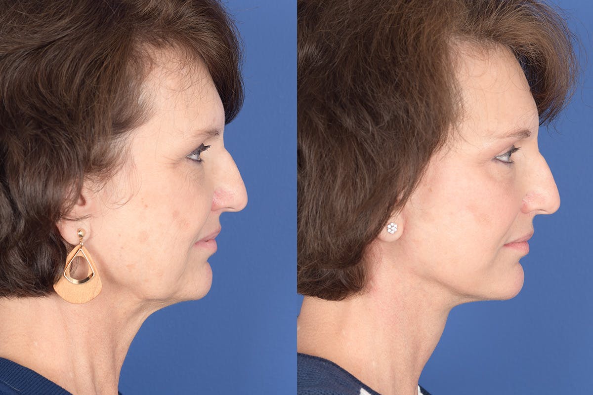 Facelift Before & After Gallery - Patient 334563 - Image 5