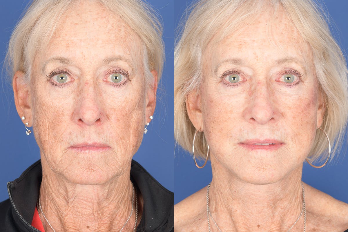 Facelift Before & After Gallery - Patient 312094 - Image 1