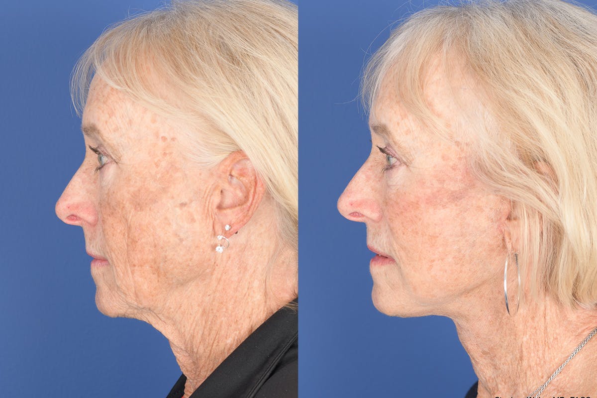 Facelift Before & After Gallery - Patient 312094 - Image 2