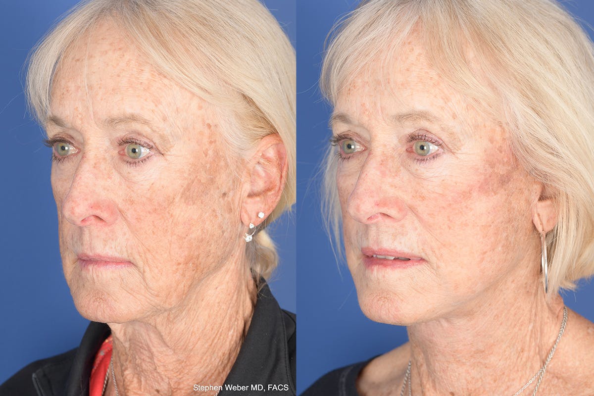 Facelift Before & After Gallery - Patient 312094 - Image 3
