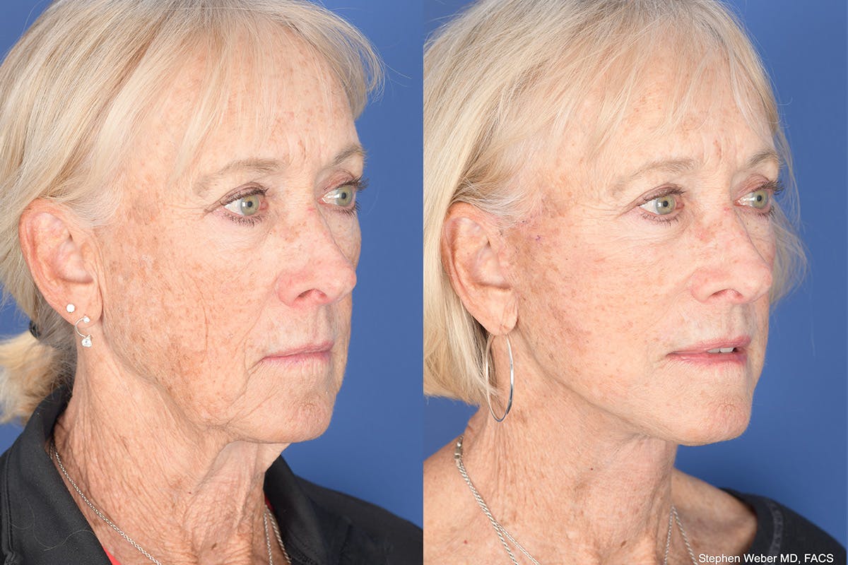 Facelift Before & After Gallery - Patient 312094 - Image 4