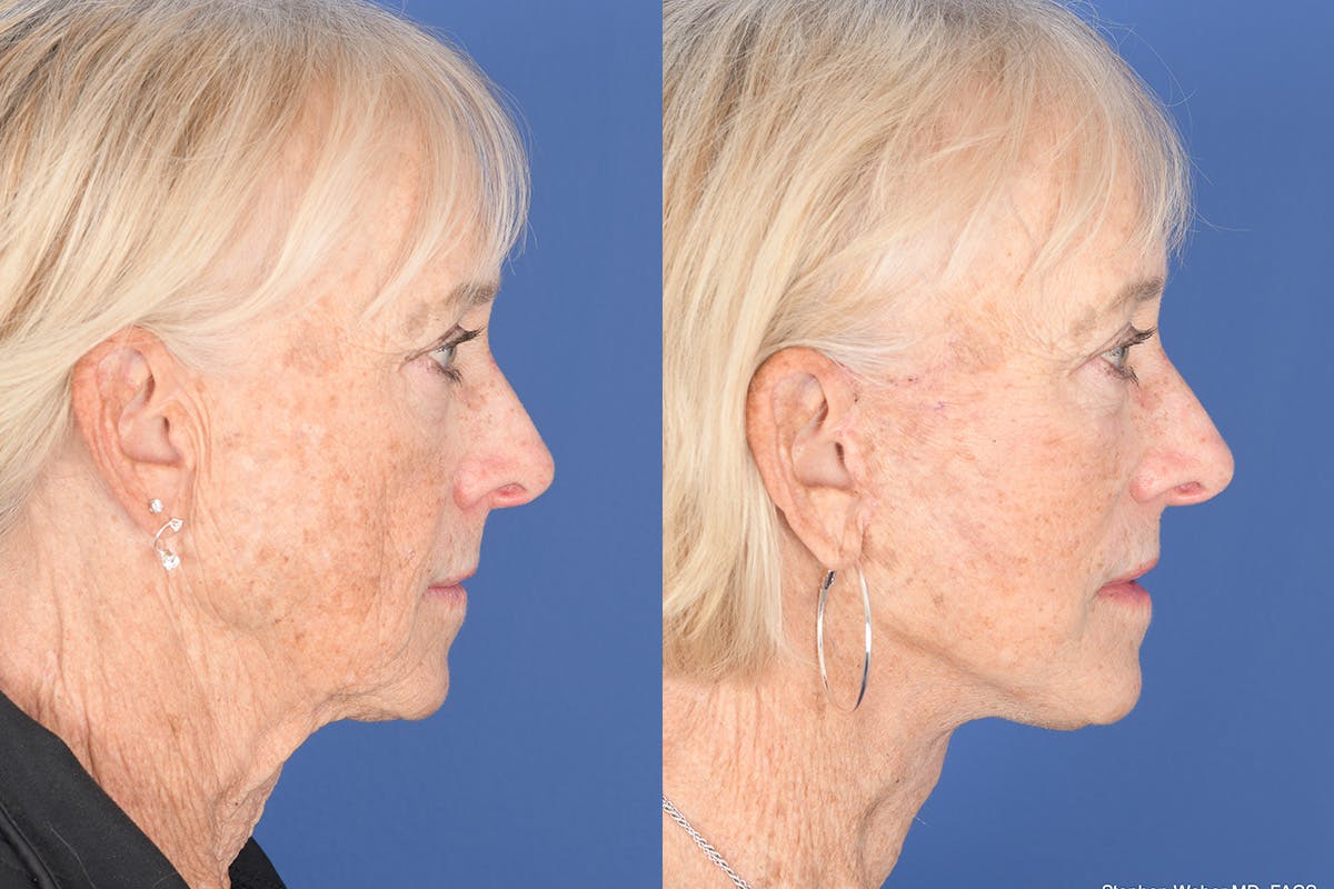 Facelift Before & After Gallery - Patient 312094 - Image 5