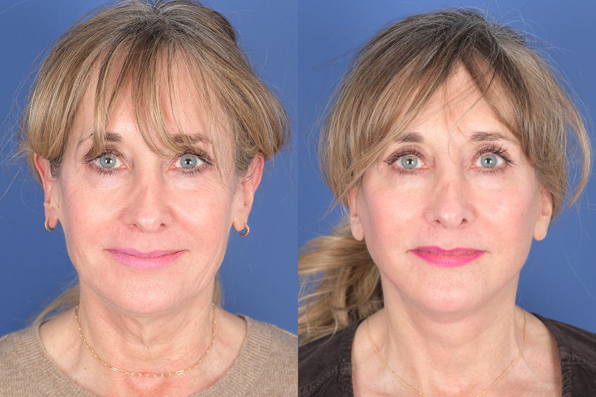 Facelift Before & After Gallery - Patient 102311 - Image 1