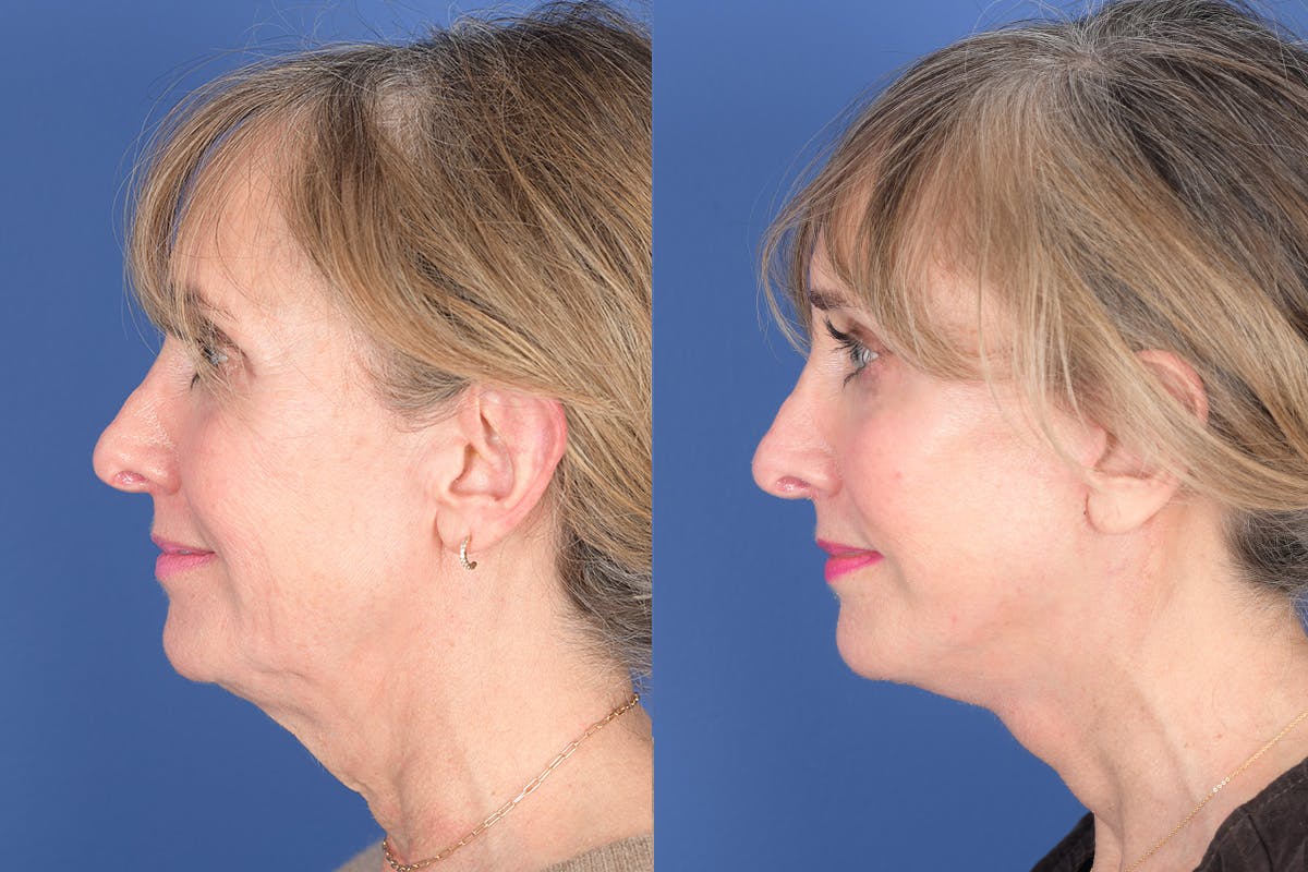 Facelift Before & After Gallery - Patient 102311 - Image 2
