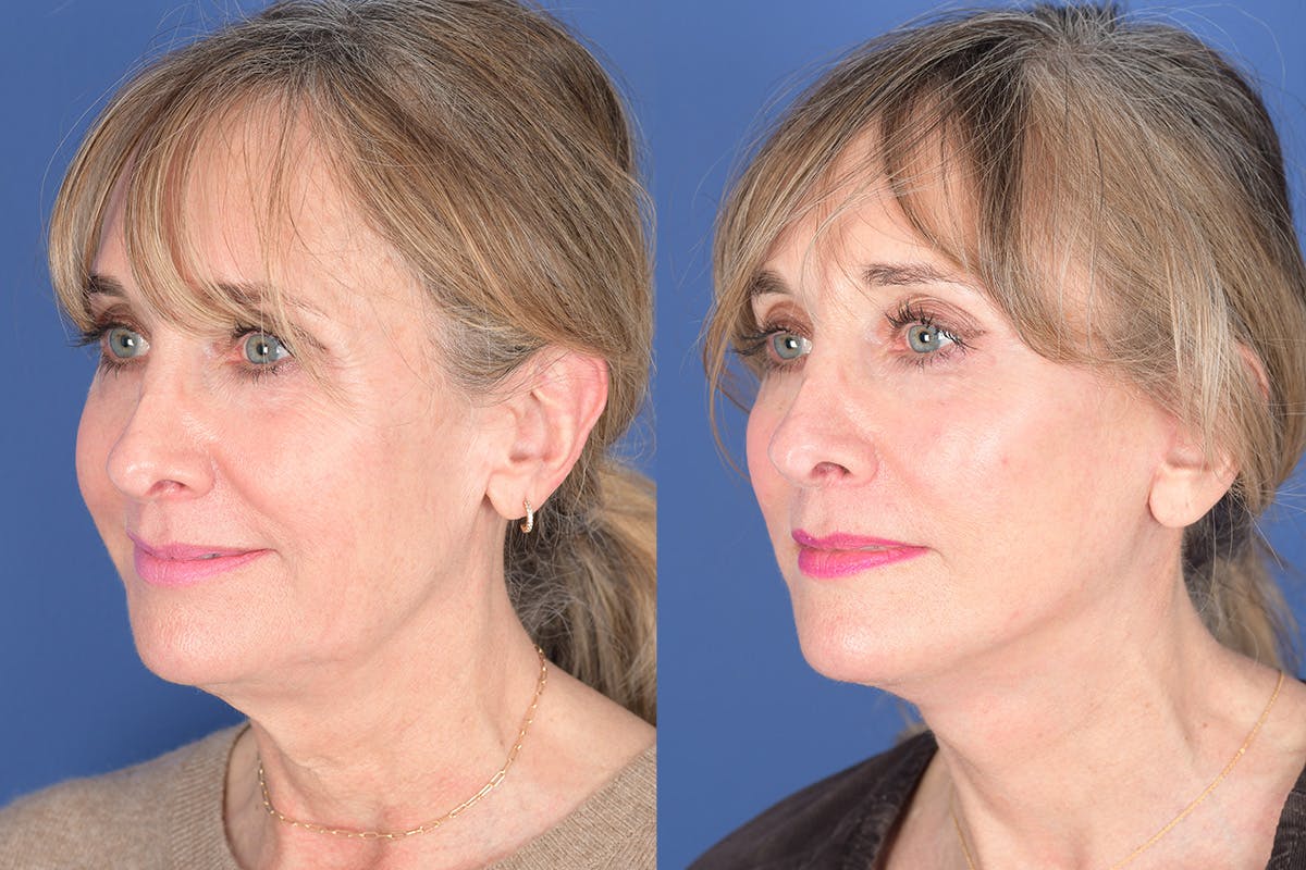 Facelift Before & After Gallery - Patient 102311 - Image 3