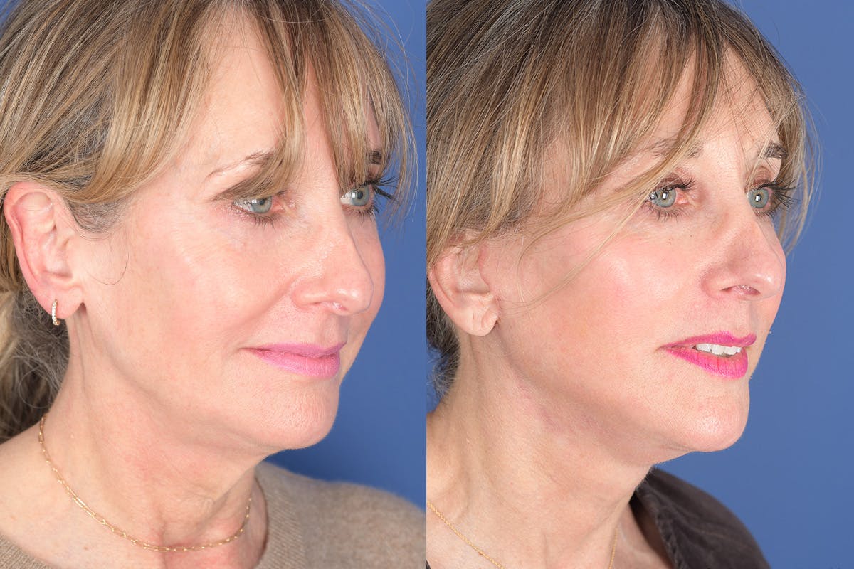 Facelift Before & After Gallery - Patient 102311 - Image 4