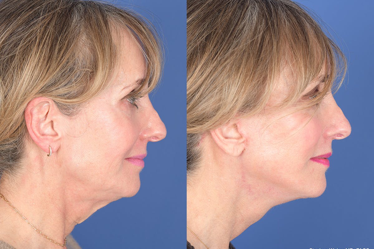 Facelift Before & After Gallery - Patient 102311 - Image 5
