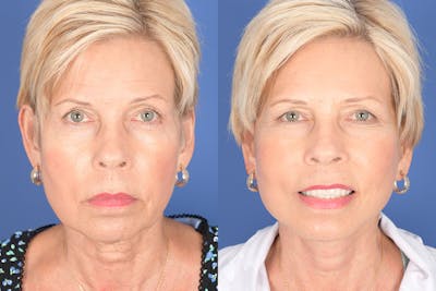 Facelift Before & After Gallery - Patient 123516 - Image 1
