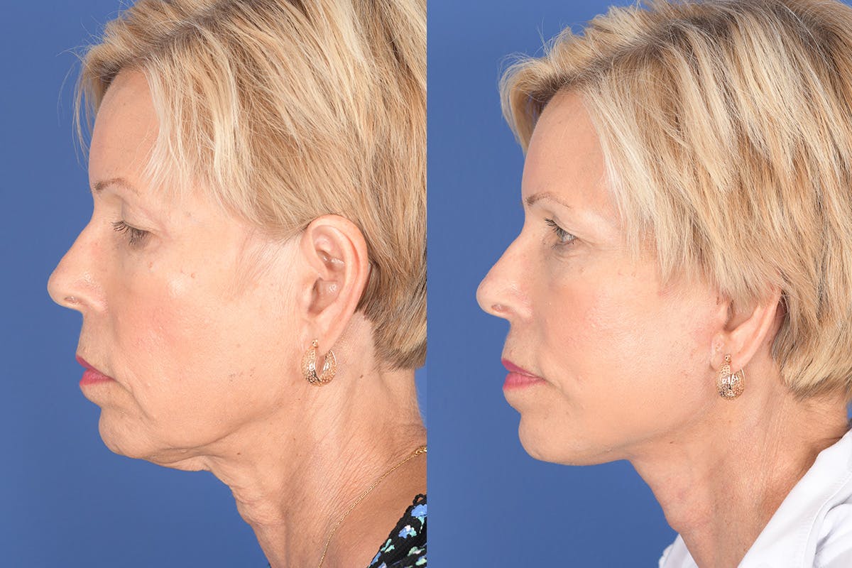 Facelift Before & After Gallery - Patient 123516 - Image 2