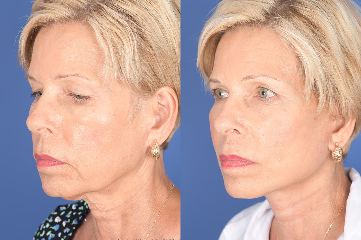 Facelift Before & After Gallery - Patient 123516 - Image 3