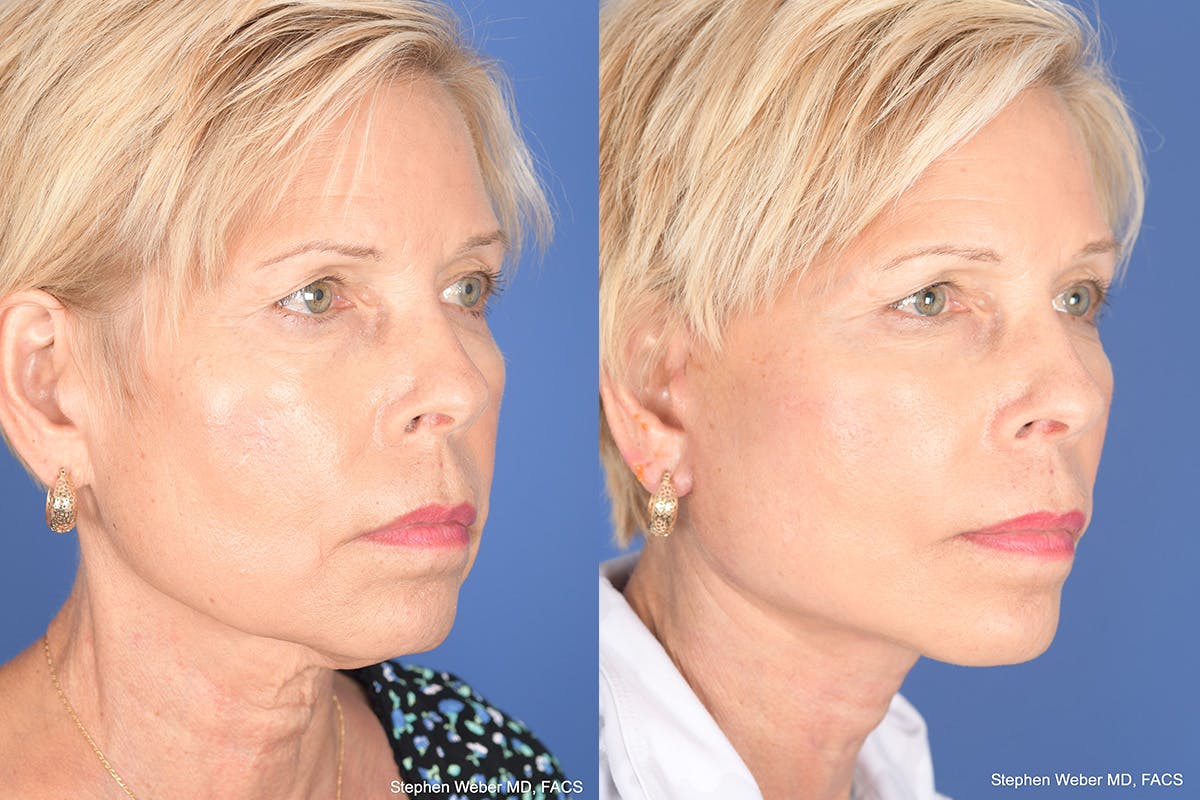 Facelift Before & After Gallery - Patient 123516 - Image 4