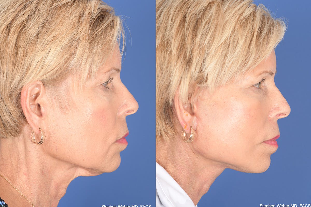 Facelift Before & After Gallery - Patient 123516 - Image 5