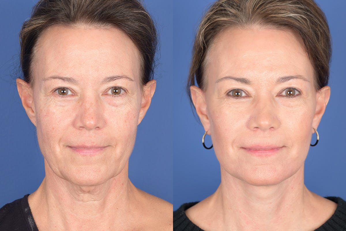 Facelift Before & After Gallery - Patient 424269 - Image 1