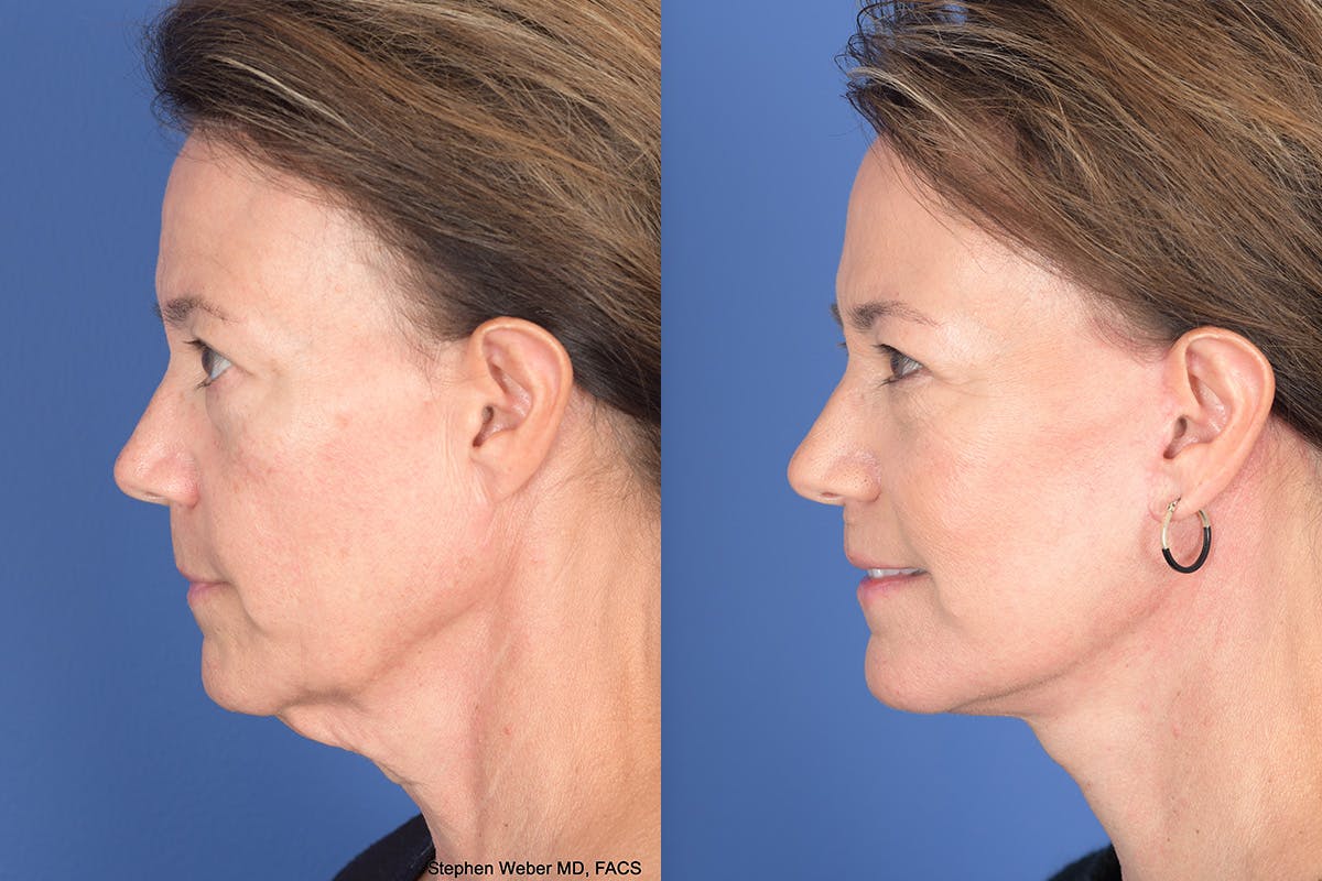 Facelift Before & After Gallery - Patient 424269 - Image 2