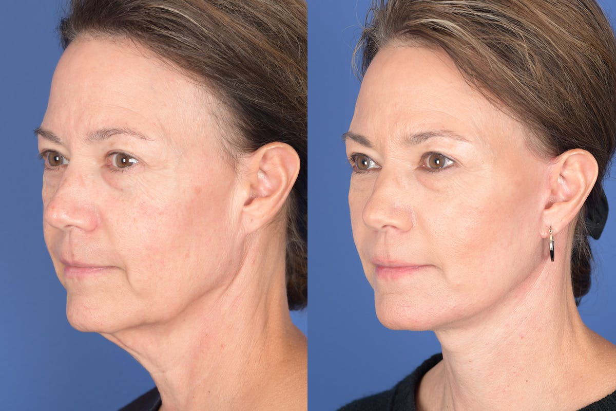 Facelift Before & After Gallery - Patient 424269 - Image 3