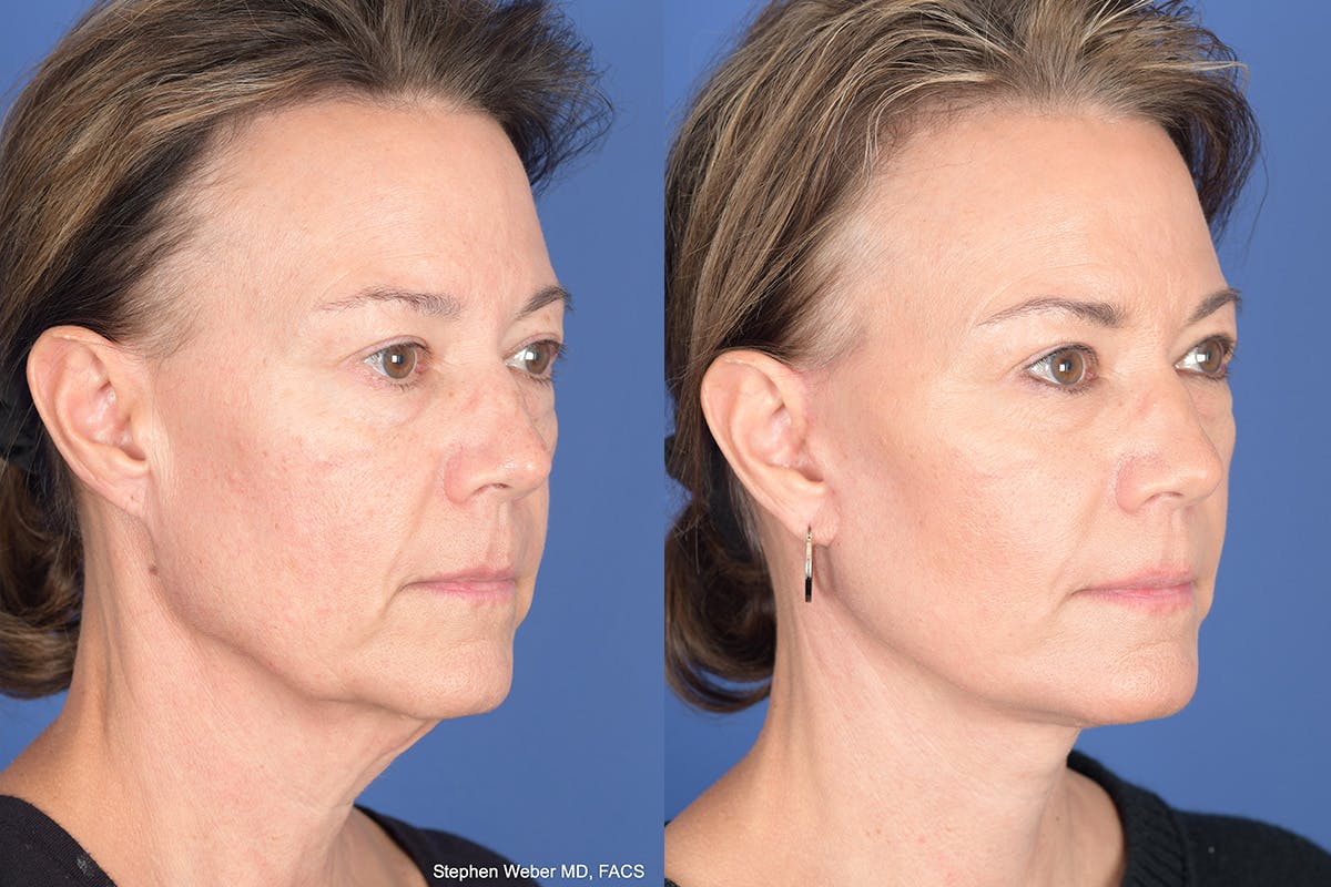 Facelift Before & After Gallery - Patient 424269 - Image 4