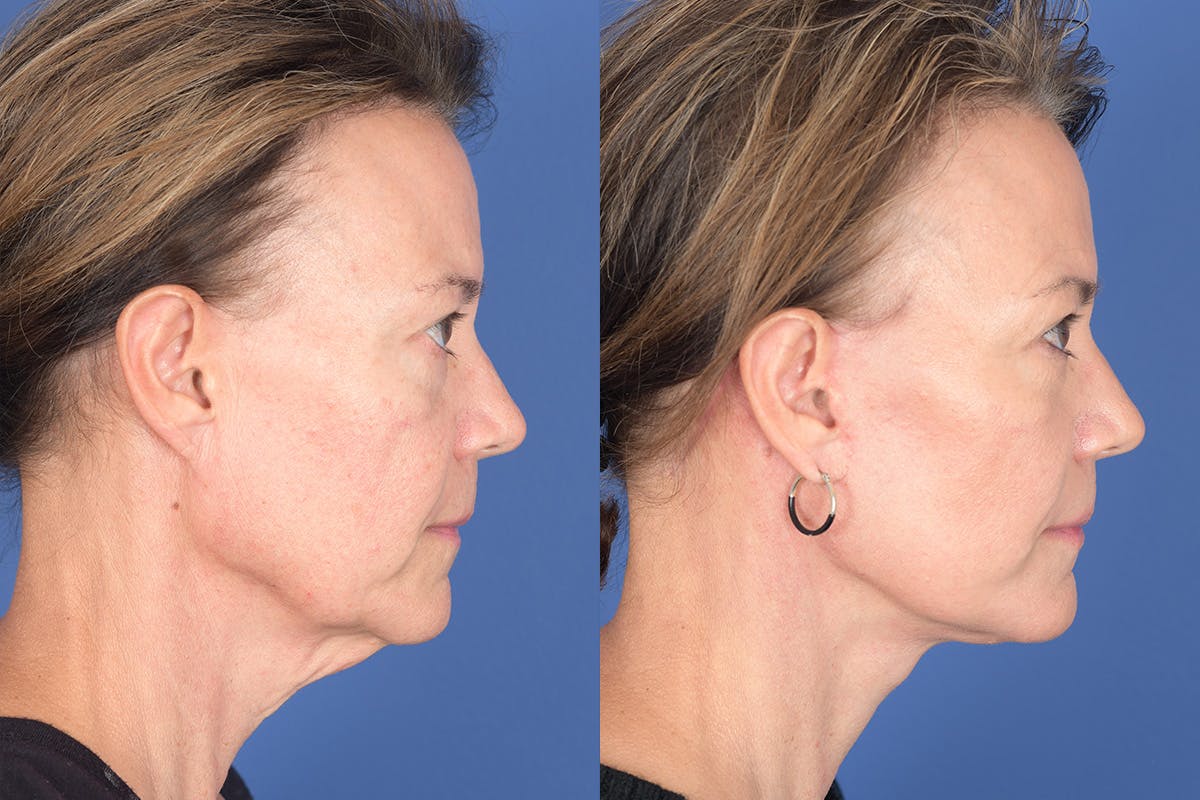 Facelift Before & After Gallery - Patient 424269 - Image 5