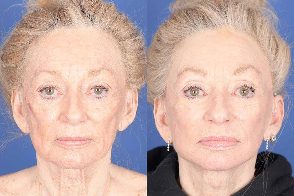 Facelift Before & After Gallery - Patient 123627 - Image 1