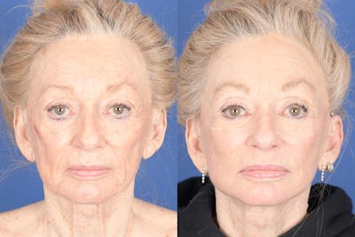 Facelift Before & After Gallery - Patient 123627 - Image 1