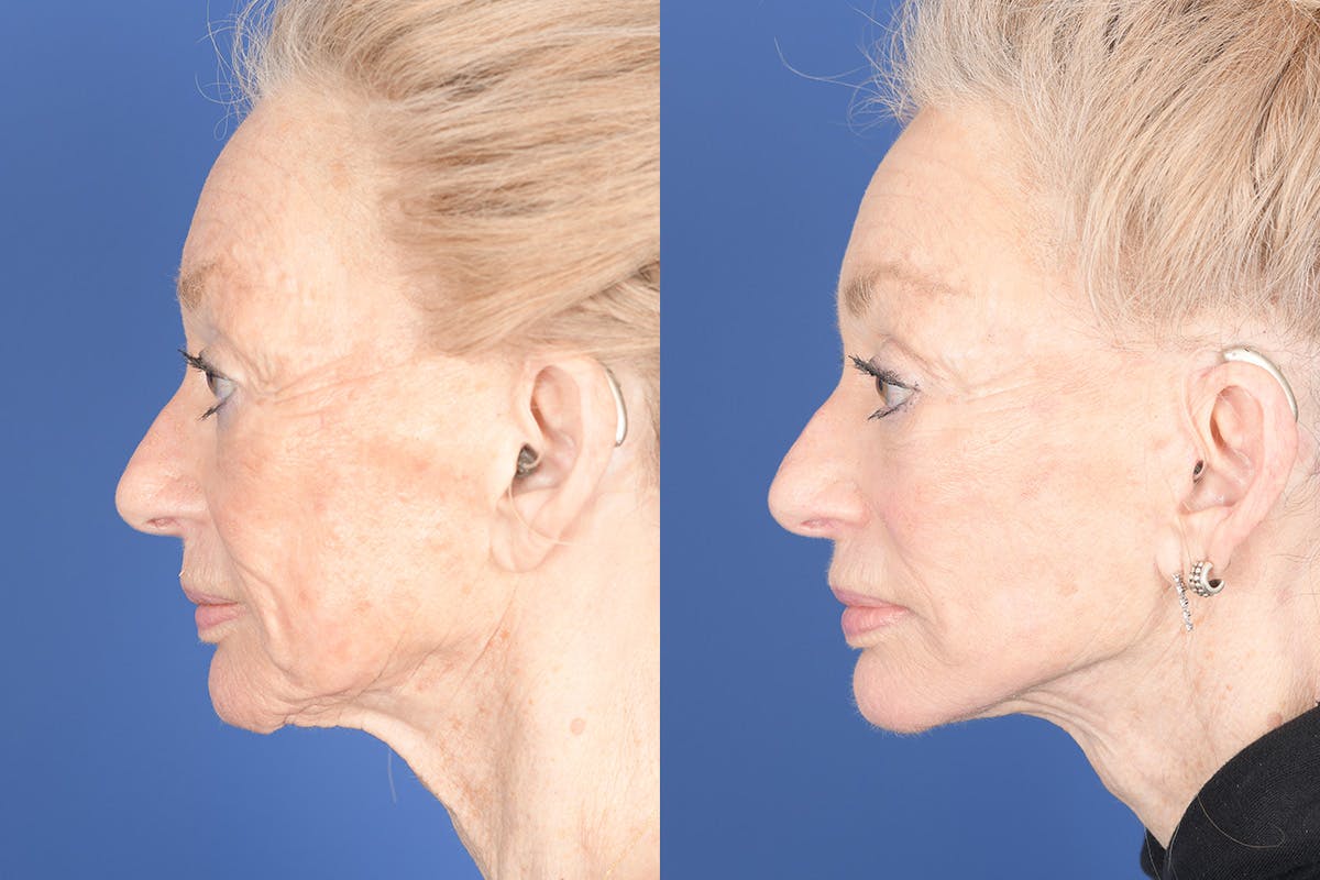 Facelift Before & After Gallery - Patient 123627 - Image 2
