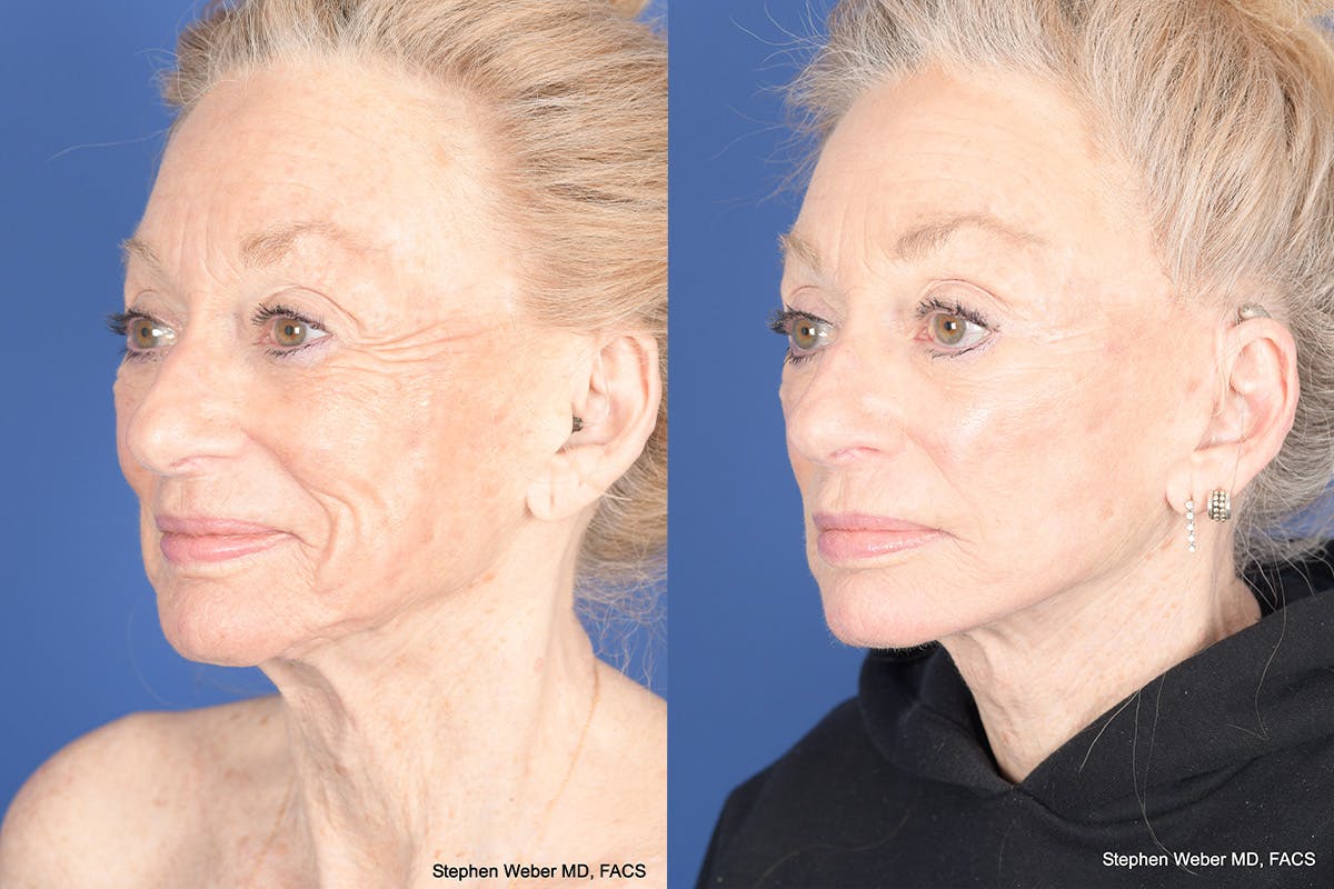 Facelift Before & After Gallery - Patient 123627 - Image 3