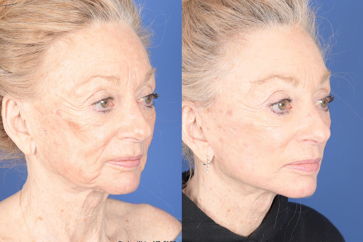 Facelift Before & After Gallery - Patient 123627 - Image 4