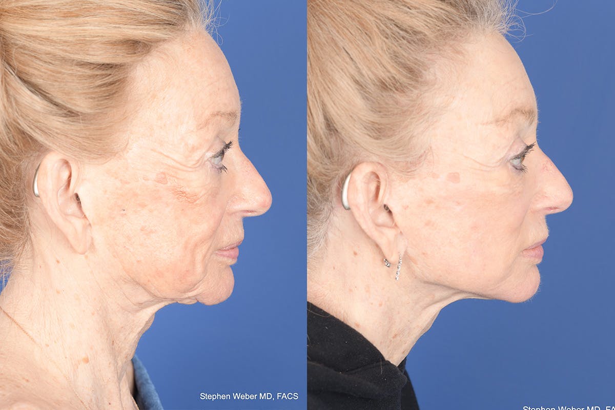 Facelift Before & After Gallery - Patient 123627 - Image 5