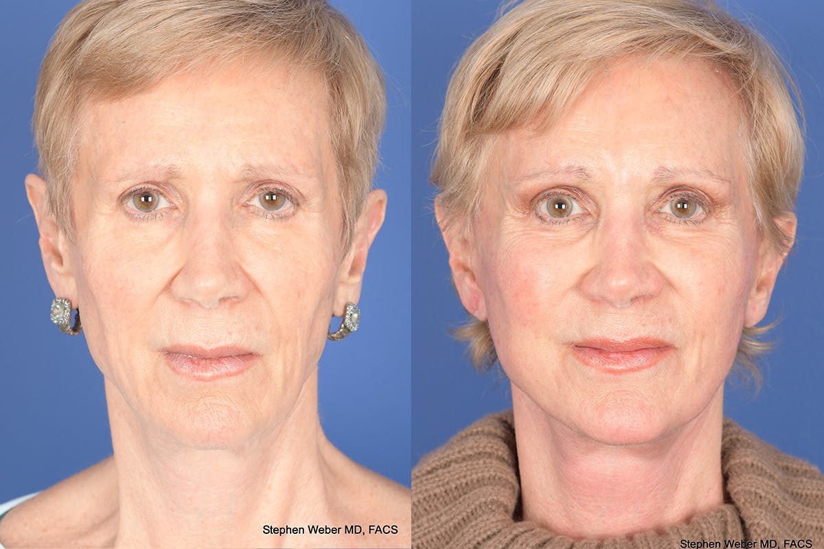 Facelift Before & After Gallery - Patient 186425 - Image 1