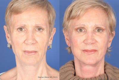 Facelift Before & After Gallery - Patient 186425 - Image 1