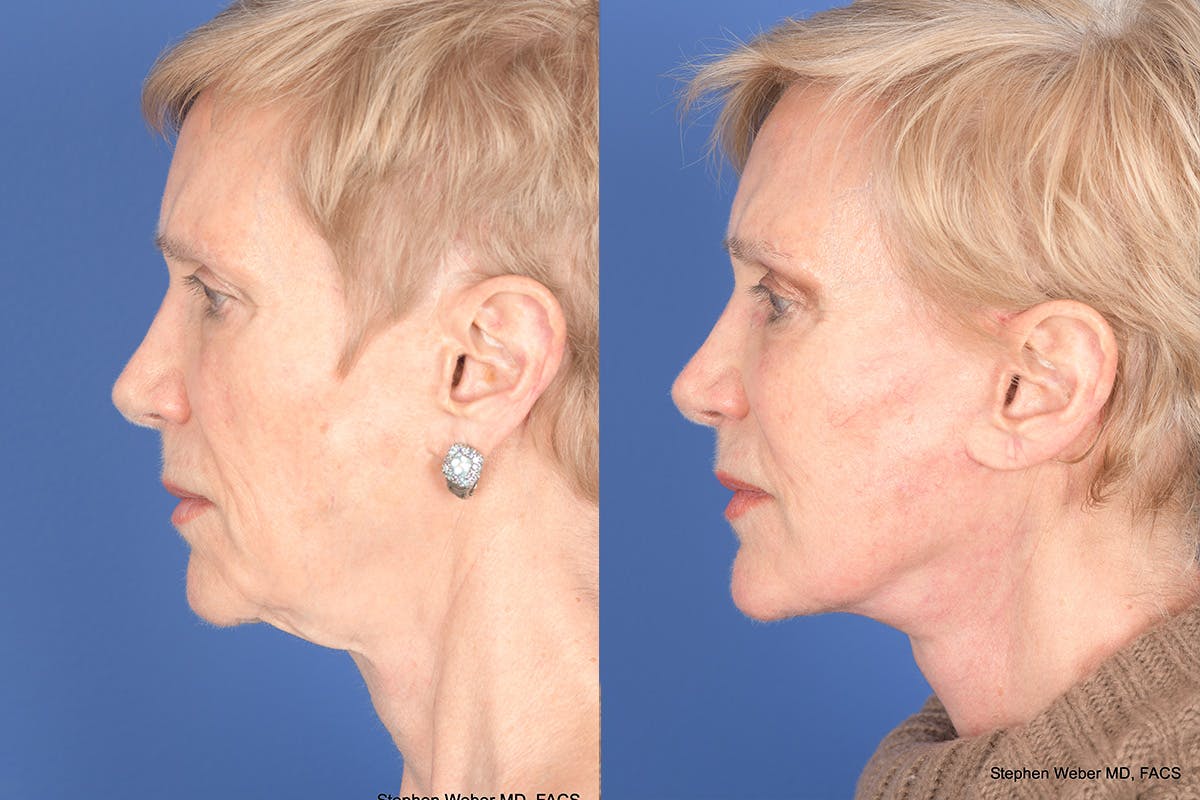 Facelift Before & After Gallery - Patient 186425 - Image 2