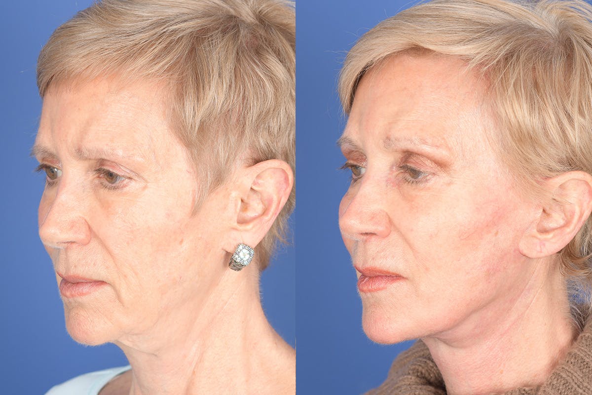 Facelift Before & After Gallery - Patient 186425 - Image 3
