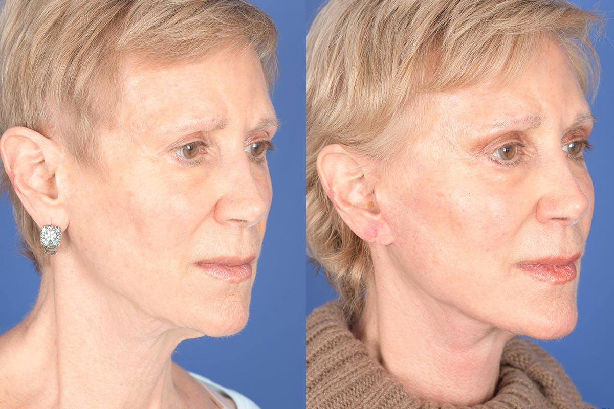 Facelift Before & After Gallery - Patient 186425 - Image 4