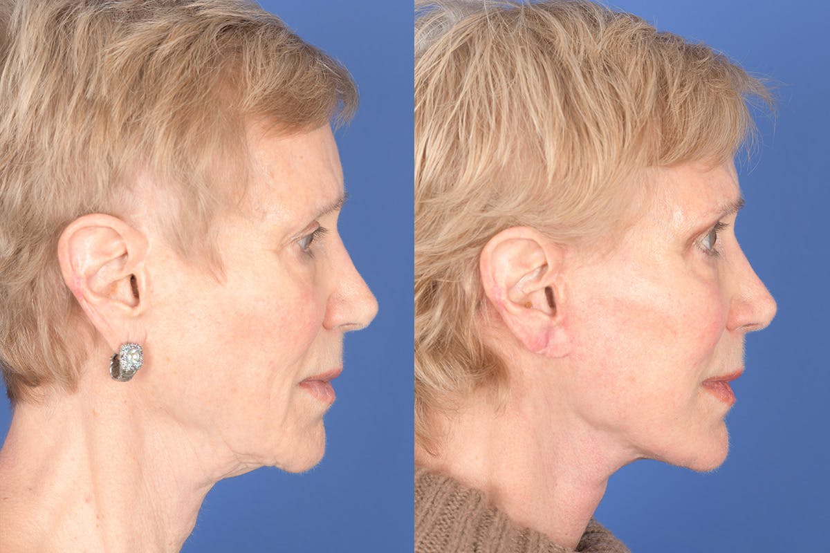 Facelift Before & After Gallery - Patient 186425 - Image 5