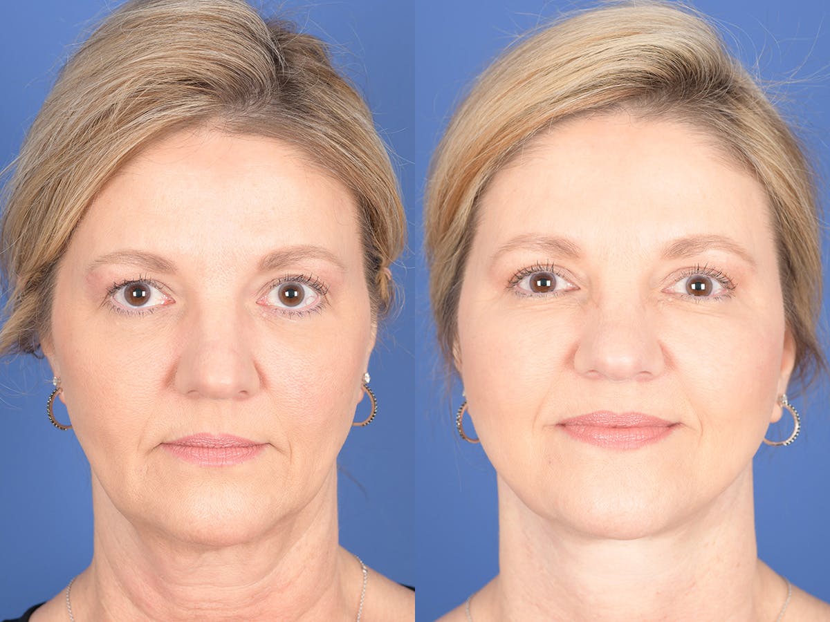 Facelift Before & After Gallery - Patient 807378 - Image 1