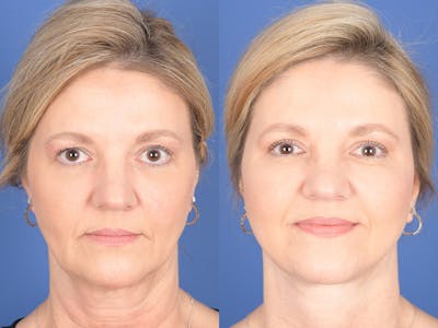 Facelift Before & After Gallery - Patient 807378 - Image 1