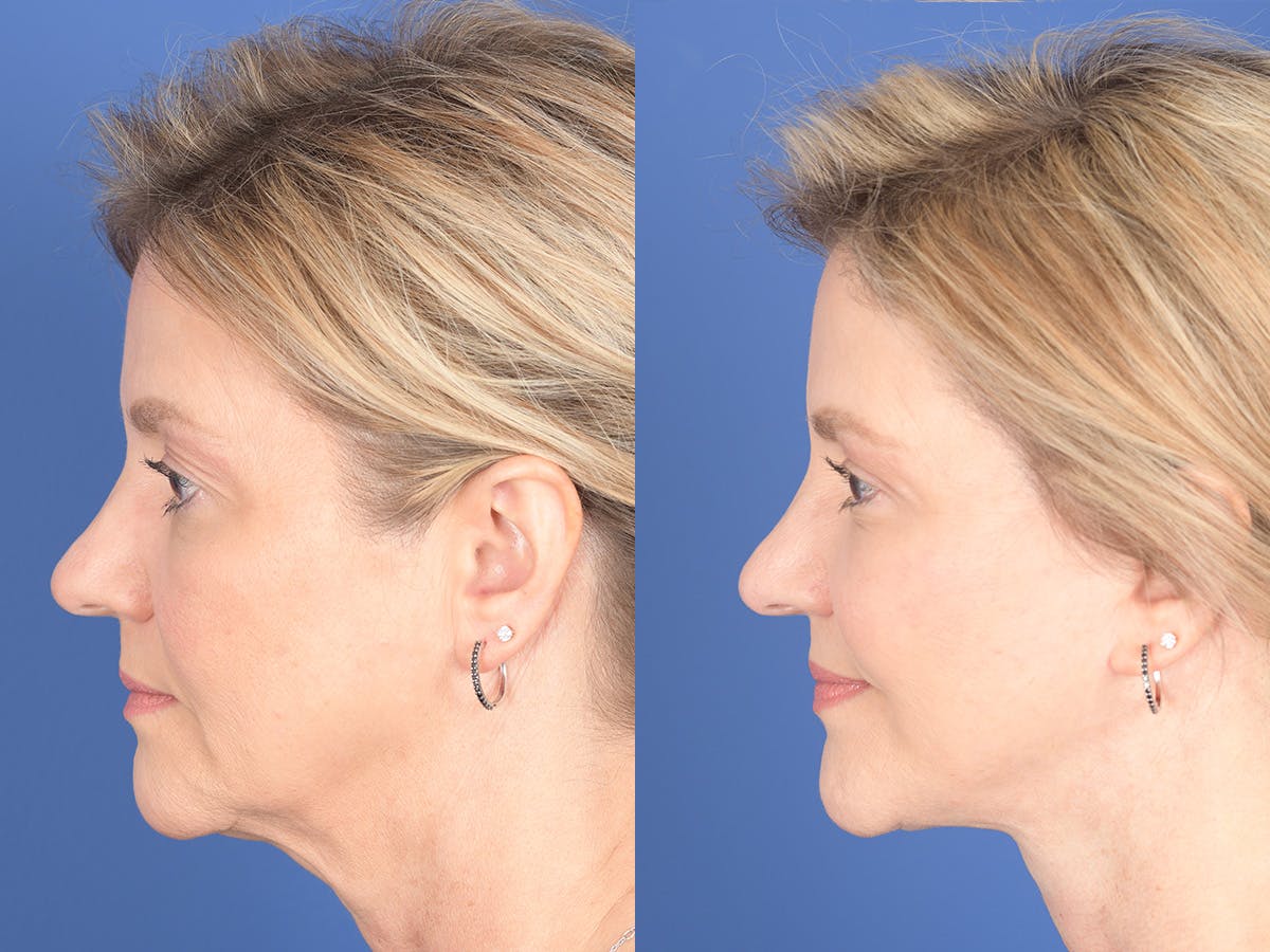 Facelift Before & After Gallery - Patient 807378 - Image 2
